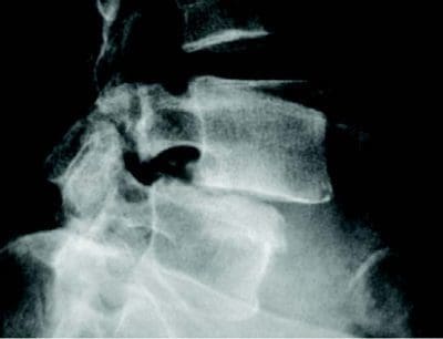 spondylolisthesis chiropractic care el paso tx.