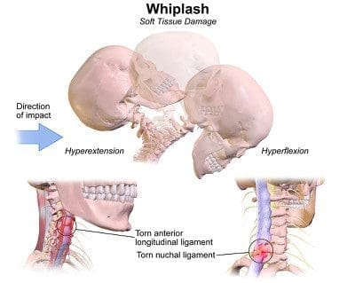 Whiplash injuries Diagram.png